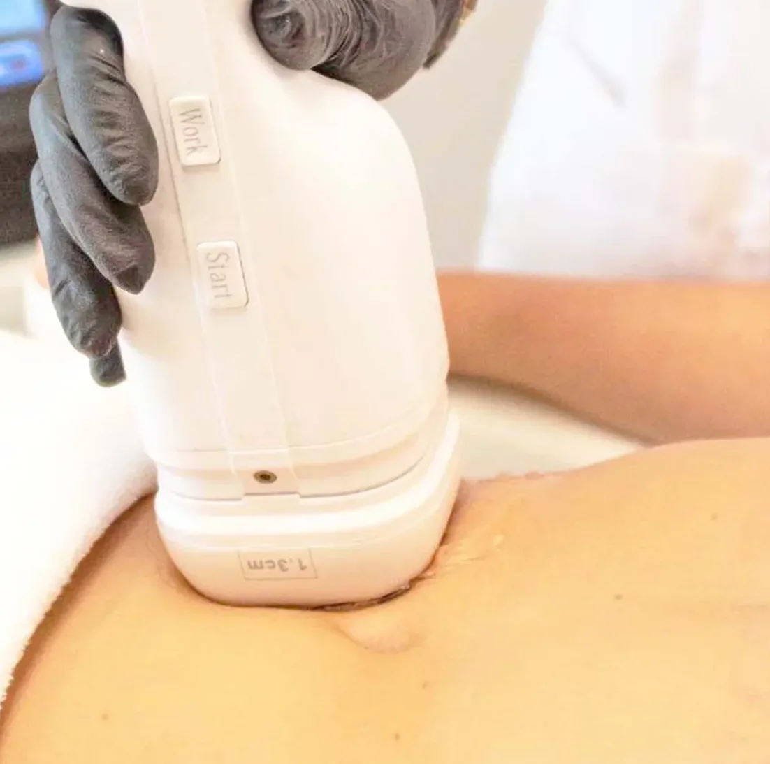 HIFU ტექნოლოგია High-Intensity Focused Ultrasound (HIFU)