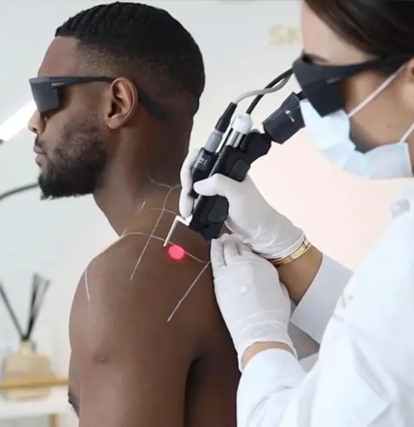 ეპილაცია ნეოდიმური ლაზერით Epilation with a neodymium laser